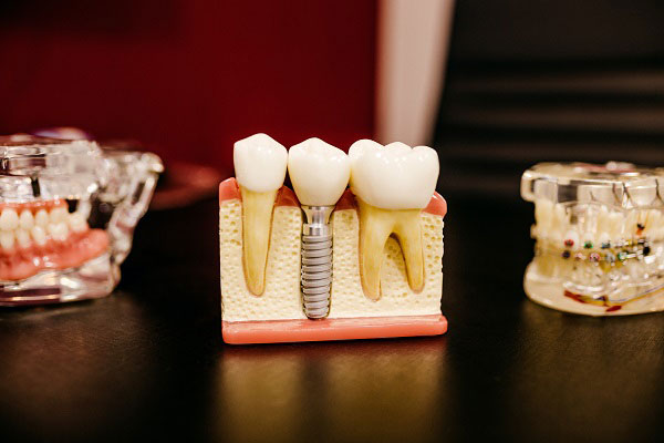 Dental Model