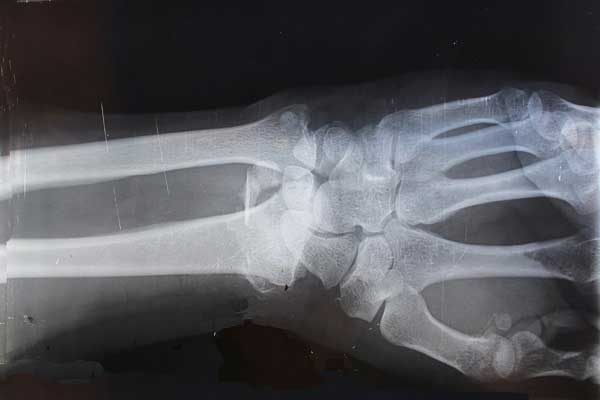 X-ray of writst